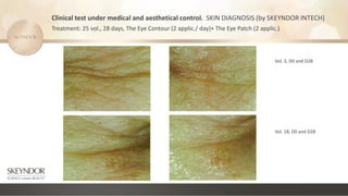 Clinical test under medical and aesthetical control. SKIN DIAGNOSIS (by SKEYNDOR INTECH)
Treatment: 25 vol., 28 days, The Eye Contour (2 applic./ day)+ The Eye Patch (2 applic.)
Vol. 3, D0 and D28
Vol. 18, D0 and D28
 