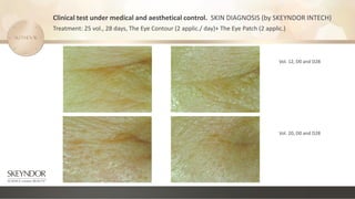 Clinical test under medical and aesthetical control. SKIN DIAGNOSIS (by SKEYNDOR INTECH)
Treatment: 25 vol., 28 days, The Eye Contour (2 applic./ day)+ The Eye Patch (2 applic.)
Vol. 12, D0 and D28
Vol. 20, D0 and D28
 