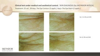 Clinical test under medical and aesthetical control. SKIN DIAGNOSIS (by SKEYNDOR INTECH)
Treatment: 25 vol., 28 days, The Eye Contour (2 applic./ day)+ The Eye Patch (2 applic.)
Vol. 13, D0 and D28
Vol. 8, D0 and D28
 
