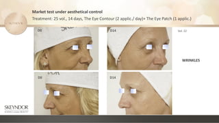 Market test under aesthetical control
Treatment: 25 vol., 14 days, The Eye Contour (2 applic./ day)+ The Eye Patch (1 applic.)
Vol. 22
D0 D14
D14
D0
WRINKLES
 
