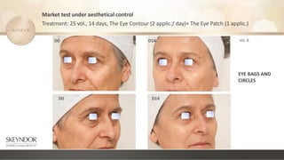 D0 D14
D14
D0
Market test under aesthetical control
Treatment: 25 vol., 14 days, The Eye Contour (2 applic./ day)+ The Eye Patch (1 applic.)
Vol. 8
EYE BAGS AND
CIRCLES
 