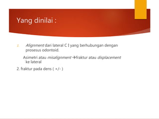 Yang dinilai :
1. Alignment dari lateral C I yang berhubungan dengan
prosesus odontoid.
Asimetri atau misalignment fraktur atau displacement
ke lateral
2. fraktur pada dens ( +/- )
 