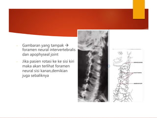 - Gambaran yang tampak 
foramen neural intervertebralis
dan apophyseal joint
- Jika pasien rotasi ke ke sisi kiri
maka akan terlihat foramen
neural sisi kanan,demikian
juga sebaliknya
 