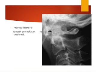 - Proyeksi lateral 
tampak peningkatan ruang
predental .
 