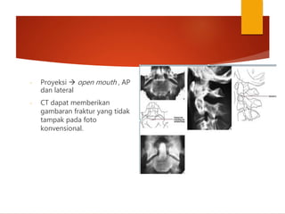 - Proyeksi  open mouth , AP
dan lateral
- CT dapat memberikan
gambaran fraktur yang tidak
tampak pada foto
konvensional.
 