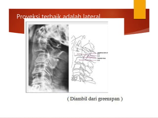 Proyeksi terbaik adalah lateral.
 
