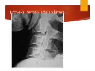 Proyeksi terbaik adalah lateral.
 