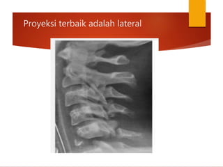 Proyeksi terbaik adalah lateral
 