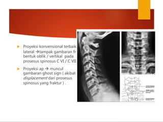  Proyeksi konvensional terbaik :
lateral tampak gambaran fr
bentuk oblik / vertikal pada
prosesus spinosus C VI / C VII.
 Proyeksi ap  muncul
gambaran ghost sign ( akibat
displacement dari prosesus
spinosus yang fraktur ) .
 