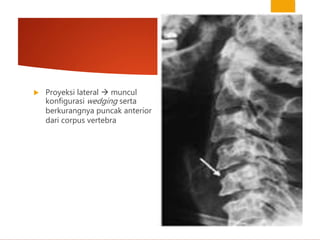  Proyeksi lateral  muncul
konfigurasi wedging serta
berkurangnya puncak anterior
dari corpus vertebra
 
