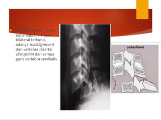  Proyeksi lateral ( cross
table lateral ) faset
bilateral terkunci,
adanya malalignment
dari vertebra disertai
disruption dari semua
garis vertebra servikalis
 
