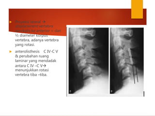  Proyeksi lateral 
displacement vertebra
servikalis ke anterior < dari
½ diameter korpus
vertebra, adanya vertebra
yang rotasi.
 anterolisthesis C IV-C V
& perubahan ruang
laminar yang mendadak
antara C IV –C V
menunjukkan rotasi
vertebra tiba –tiba.
 