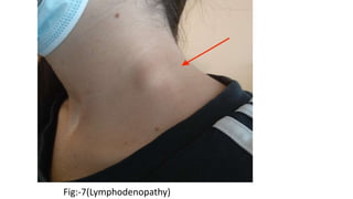 Fig:-7(Lymphodenopathy)
 
