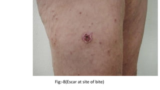 Fig:-8(Escar at site of bite)
 