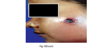 Fig:-9(Escar)
 