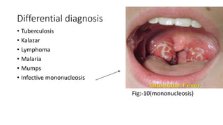 Differential diagnosis
• Tuberculosis
• Kalazar
• Lymphoma
• Malaria
• Mumps
• Infective mononucleosis
Fig:-10(mononucleosis)
 