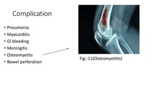 Complication
• Pneumonia
• Myocarditis
• GI bleeding
• Meningitis
• Osteomyetits
• Bowel perforation
Fig:-11(Osteomyetitis)
 