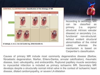 Causes of primary MR include most commonly degenerative disease (Barlow,
fibroelastic degeneration, Marfan, Ehlers-Danlos, annular calcification), rheumatic
disease, toxic valvulopathy, and endocarditis. Ruptured papillary muscle secondary
to myocardial infarction is included as primary ischaemic MR. Secondary MR
develops despite a structurally normal mitral valve in the context of ischaemic heart
disease, dilated cardiomyopathy, or severe LA dilatation
According to aetiology, MR
can be classified as
primary (i.e. organic/
structural: intrinsic valvular
disease) or secondary (i.e.
functional/ non-structural:
without evident structural
abnormalities of the mitral
valve) whereas the
mechanism is based on
Carpentier’s classification.
 