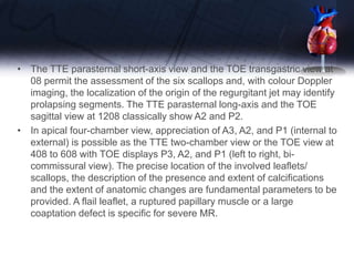 • The TTE parasternal short-axis view and the TOE transgastric view at
08 permit the assessment of the six scallops and, with colour Doppler
imaging, the localization of the origin of the regurgitant jet may identify
prolapsing segments. The TTE parasternal long-axis and the TOE
sagittal view at 1208 classically show A2 and P2.
• In apical four-chamber view, appreciation of A3, A2, and P1 (internal to
external) is possible as the TTE two-chamber view or the TOE view at
408 to 608 with TOE displays P3, A2, and P1 (left to right, bi-
commissural view). The precise location of the involved leaflets/
scallops, the description of the presence and extent of calcifications
and the extent of anatomic changes are fundamental parameters to be
provided. A flail leaflet, a ruptured papillary muscle or a large
coaptation defect is specific for severe MR.
 