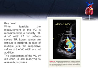 Key point :
When feasible, the
measurement of the VC is
recommended to quantify TR.
A VC width ≥7 mm defines
severe TR. Lower values are
difficult to interpret. In case of
multiple jets, the respective
values of the VC width are not
additive.
The assessment of the VC by
3D echo is still reserved to
research purposes.
 