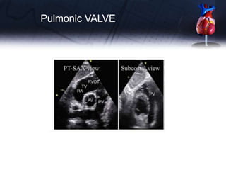 Pulmonic VALVE
 
