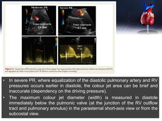 • In severe PR, where equalization of the diastolic pulmonary artery and RV
pressures occurs earlier in diastole, the colour jet area can be brief and
inaccurate (dependency on the driving pressure).
• The maximum colour jet diameter (width) is measured in diastole
immediately below the pulmonic valve (at the junction of the RV outflow
tract and pulmonary annulus) in the parasternal short-axis view or from the
subcostal view.
 