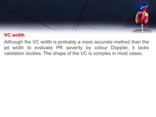 VC width
Although the VC width is probably a more accurate method than the
jet width to evaluate PR severity by colour Doppler, it lacks
validation studies. The shape of the VC is complex in most cases.
 