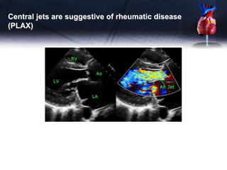 Central jets are suggestive of rheumatic disease
(PLAX)
 