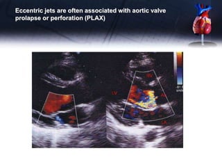 Eccentric jets are often associated with aortic valve
prolapse or perforation (PLAX)
 
