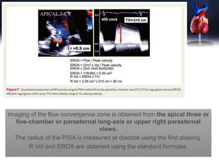 Imaging of the flow convergence zone is obtained from the apical three or
five-chamber or parasternal long-axis or upper right parasternal
views.
The radius of the PISA is measured at diastole using the first aliasing.
R Vol and EROA are obtained using the standard formulas.
 