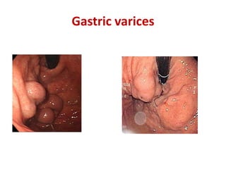 Gastric varices
 