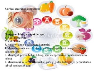 Corneal ulceration with xerosis 
Gangguan lainnya dapat berupa: 
1. Kulit mengering 
2. Kulit kasar 
3. Kadar vitamin a berkurang (Anemia) 
4. Mempengaruhi sistem tulang dan syaraf, dan dapat mengakibatkan 5. 
kelumpuhan. 
6. Mencegah pertumbuhan tulang, atau menyebabkan perubahan bentuk 
tulang. 
7. Membentuk celah dan kerusakan pada gigi dan terhentinya pertumbuhan 
sel-sel pembentuk gigi. 
 