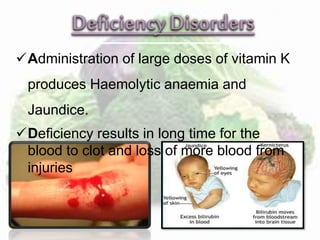 Administration of large doses of vitamin K 
produces Haemolytic anaemia and 
Jaundice. 
Deficiency results in long time for the 
blood to clot and loss of more blood from 
injuries 
 