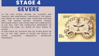 IN THE LAST STAGE, SEVERE AD, PLAQUES AND
TANGLES ARE WIDESPREAD THROUGHOUT THE BRAIN,
AND AREAS OF THE BRAIN HAVE ATROPHIED FURTHER
(SEE THE IMAGES BELOW). PATIENTS CANNOT
RECOGNIZE FAMILY AND LOVED ONES OR COMMUNICATE
IN ANY WAY. THEY ARE COMPLETELY DEPENDENT ON
OTHERS FOR CARE. ALL SENSE OF SELF SEEMS TO
VANISH.
IN END-STAGE AD, PATIENTS MAY BE IN BED MUCH OR
ALL OF THE TIME. DEATH IS OFTEN THE RESULT OF
OTHER ILLNESSES, FREQUENTLY ASPIRATION
PNEUMONIA.
SEVERE
STAGE 4
 