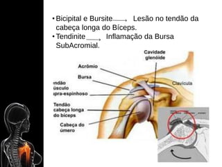 • Bicipital e Bursite Lesão no tendão da
cabeça longa do Bíceps.
• Tendinite Inflamação da Bursa
SubAcromial.
 