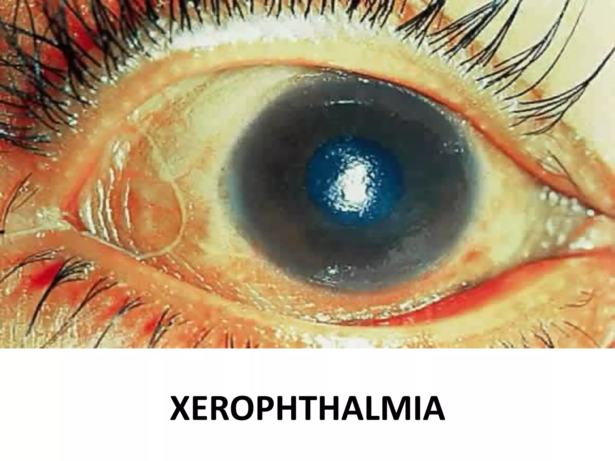 ppt xeropthalmia.pptx