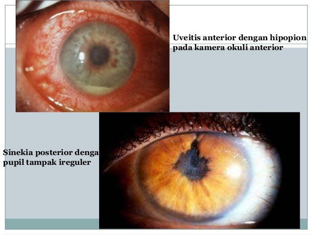 Asuhan Keperawatan Penyakit Uveitis Mata