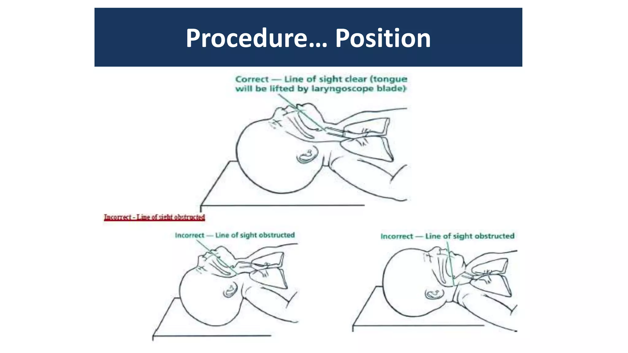 positive pressure ventilation in NRP PPT