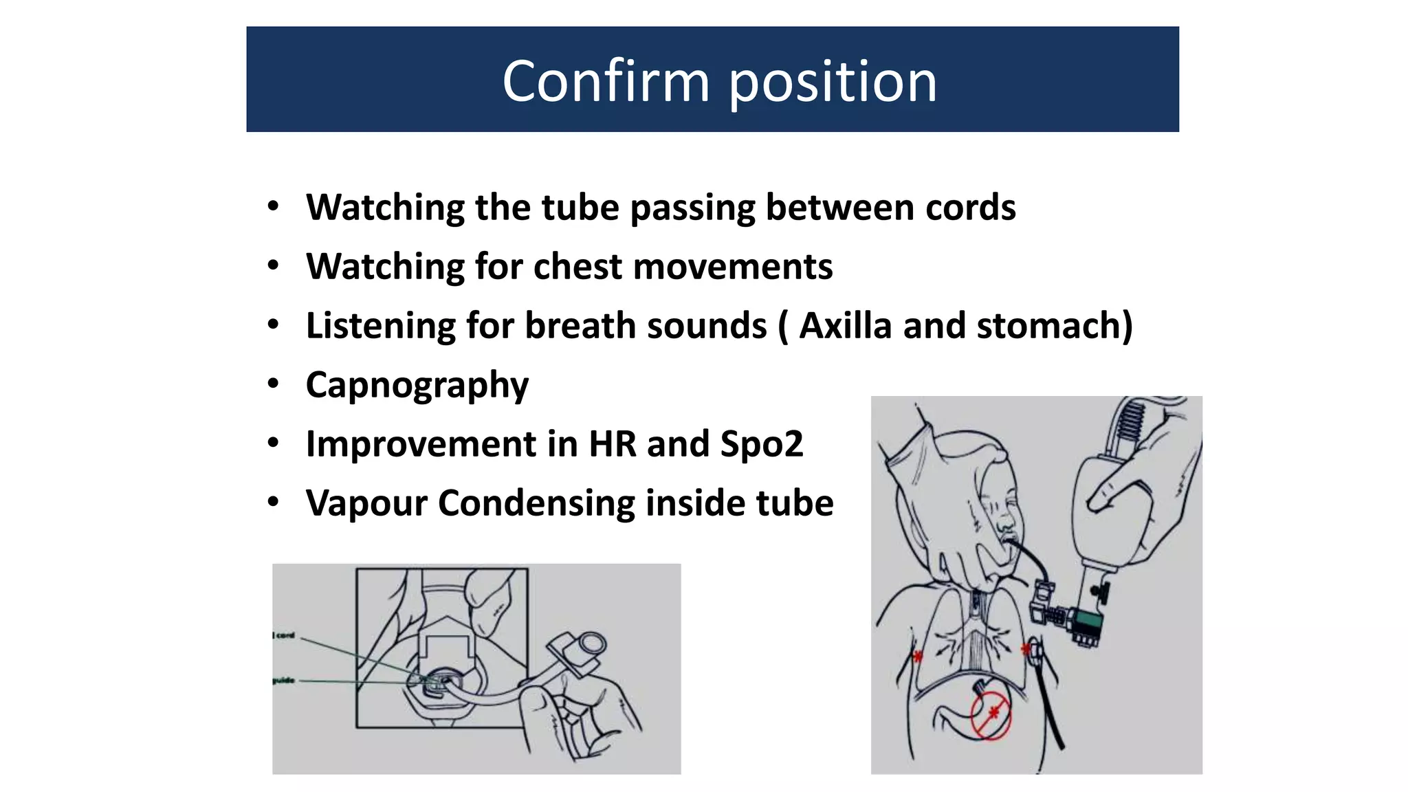 positive pressure ventilation in NRP PPT