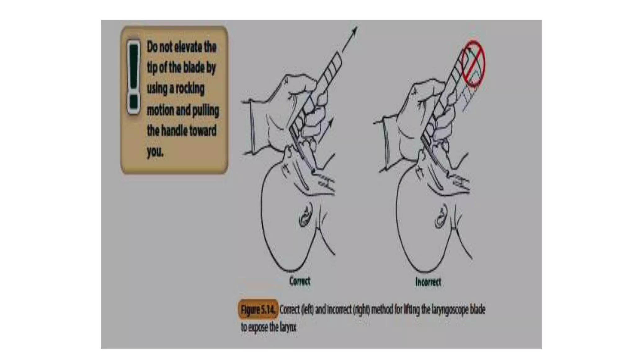 positive pressure ventilation in NRP PPT