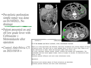 • Pre-pyloric perforation
simple repair was done
on 01/10/2021, No
drainage
• Patient presented on and
off low grade fever with
Ceftriaxone +
Metronidazole after
operation
• Control Abd+Pelvic CT
on 2021/10/18 >
 