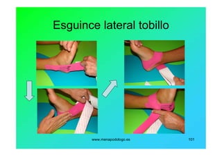 www.menapodologo.es 101
Esguince lateral tobillo
 