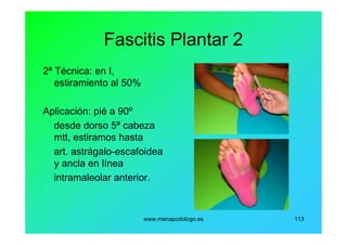 www.menapodologo.es 113
Fascitis Plantar 2
2ª Técnica: en I,
estiramiento al 50%
Aplicación: pié a 90º
desde dorso 5ª cabeza
mtt, estiramos hasta
art. astrágalo-escafoidea
y ancla en línea
intramaleolar anterior.
 