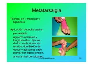 www.menapodologo.es 115
Metatarsalgia
Técnica: en I, muscular y
ligamento
Aplicación: decúbito supino
pie relajado.
agujeros centrales y
longitudinales, fijar los
dedos, ancla dorsal sin
tensión, dorsiflexión de
dedos y aplicamos cabo
plantar con ligera tensión.
ancla a nivel de calcáneo.
 