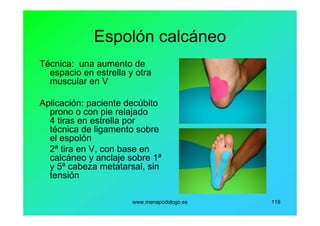 www.menapodologo.es 118
Espolón calcáneo
Técnica: una aumento de
espacio en estrella y otra
muscular en V
Aplicación: paciente decúbito
prono o con pie relajado
4 tiras en estrella por
técnica de ligamento sobre
el espolón
2ª tira en V, con base en
calcáneo y anclaje sobre 1ª
y 5ª cabeza metatarsal, sin
tensión
 