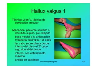 www.menapodologo.es 120
Hallux valgus 1
Técnica: 2 en V, técnica de
corrección articular
Aplicación: paciente sentado o
decúbito supino, pie relajado.
base medial a la articulación
metatarso-falángica 1er dedo
1er cabo sobre planta borde
interno del pie y el 2º cabo
algo dorsal del borde
interno, con estiramiento
máximo
anclas en calcáneo
 