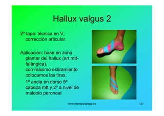 www.menapodologo.es 121
Hallux valgus 2
2º tape: técnica en V,
corrección articular.
Aplicación: base en zona
plantar del hallux (art mtt-
falángica).
con máximo estiramiento
colocamos las tiras.
1ª ancla en dorso 5ª
cabeza mtt y 2ª a nivel de
maleolo peroneal
 