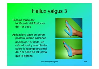 www.menapodologo.es 123
Hallux valgus 3
Técnica muscular
tonificante del Abductor
del 1er dedo
Aplicación: base en borde
postero interno calcáneo
anclas en 1er dedo, un
cabo dorsal y otro plantar
sobre la falange proximal
del 1er dedo de tal forma
que lo abraza.
 