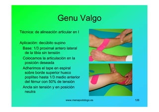 www.menapodologo.es 126
Genu Valgo
Técnica: de alineación articular en I
Aplicación: decúbito supino
Base: 1/3 proximal antero lateral
de la tibia sin tensión
Colocamos la articulación en la
posición deseada
Adherimos el tape en espiral
sobre borde superior hueco
poplíteo hasta 1/3 medio anterior
del fémur con 50% de tensión
Ancla sin tensión y en posición
neutra
 