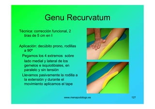 www.menapodologo.es 127
Genu Recurvatum
Técnica: corrección funcional, 2
tiras de 5 cm en I
Aplicación: decúbito prono, rodillas
a 90º
Pegamos los 4 extremos sobre
lado medial y lateral de los
gemelos e isquiotibiales, en
paralelo y sin tensión
Llevamos pasivamente la rodilla a
la extensión y durante el
movimiento aplicamos el tape
 